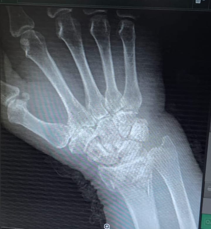 64F rt. wrist fracture, Metabolic Syn, Dyspnea 25 yrs Telangana PaJR