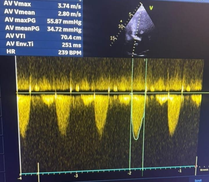 51M Incidental Aortic stenosis 2016 metabolic syn 2020 Htn 1 yr WB PaJR