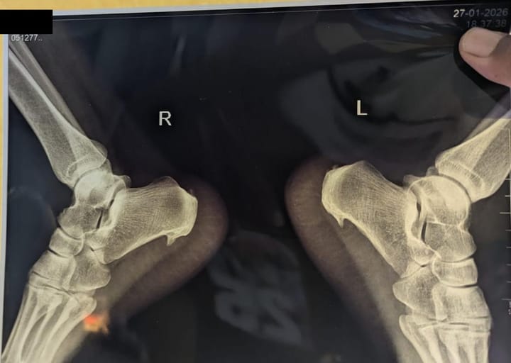 48F Heel and Knee Pains Karnataka PaJR