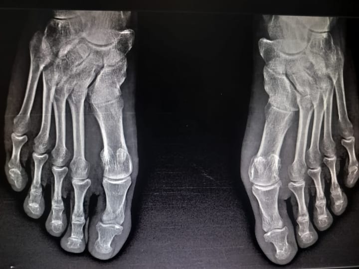 56M traumatic pain in the left knee and base of the left great toe
1 day Telangana PaJR